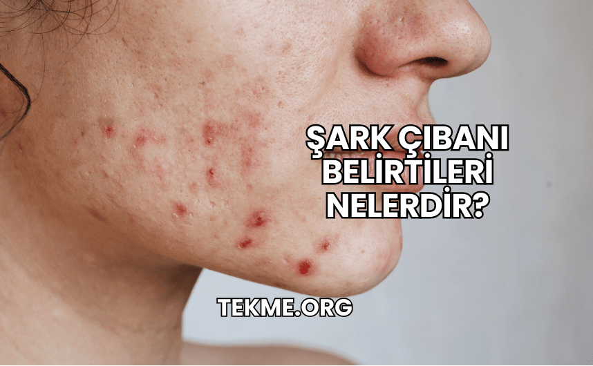 Şark Çıbanı Belirtileri Nelerdir?