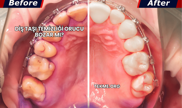 Diş Taşı Temizliği Orucu Bozar mı?